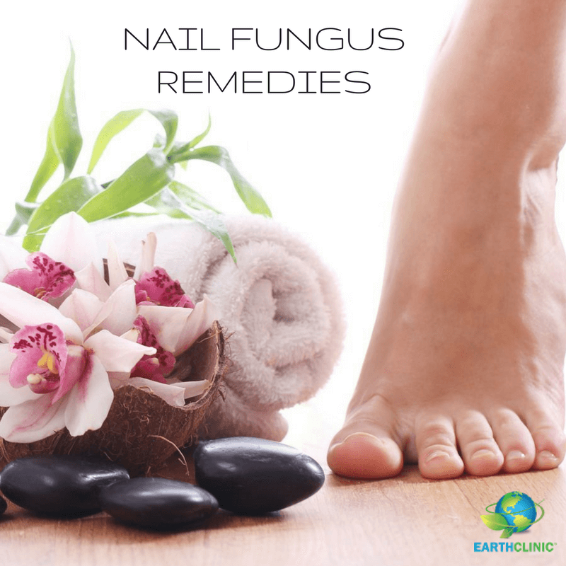 NaIl Fungus Natural Remedies